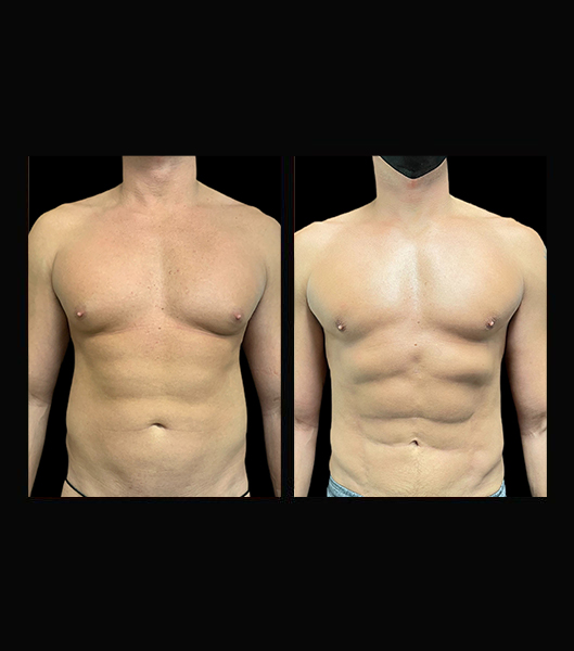Closeup of man's abs before and after vaser 4 D liposculpt