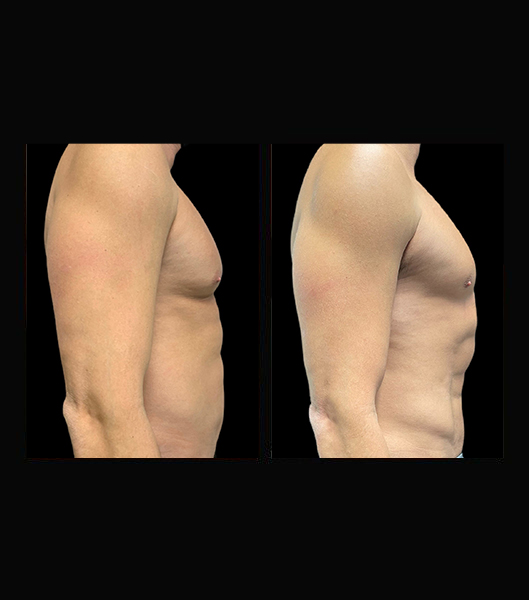 Patient's side profile before and after vaser 4 D liposculpt