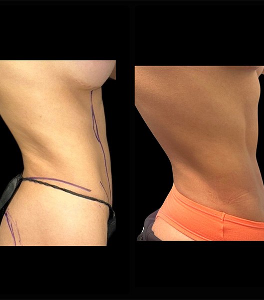 Patient's side profile before and after vaser 4 D liposculpt