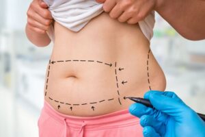 Surgeon marking patient’s belly, preparing for a tummy tuck