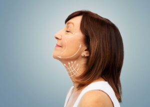 Side profile of mature woman with arrows on her face, signifying facelift