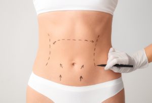 Woman’s abdomen being prepared for a tummy tuck in Chicago