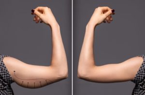 Woman’s arm before and after brachioplasty