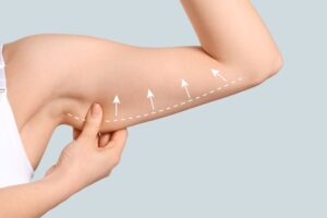 Woman’s arm with sagging skin that may benefit from brachioplasty