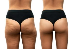 Woman’s backside before and after cellulite reduction