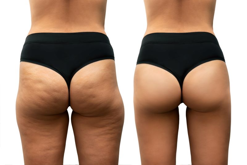 4 Reasons to Consider Cellulite Reduction