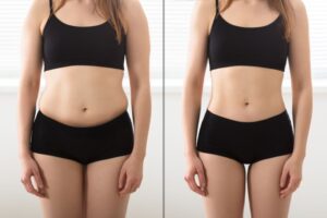 Woman’s body before and after liposuction